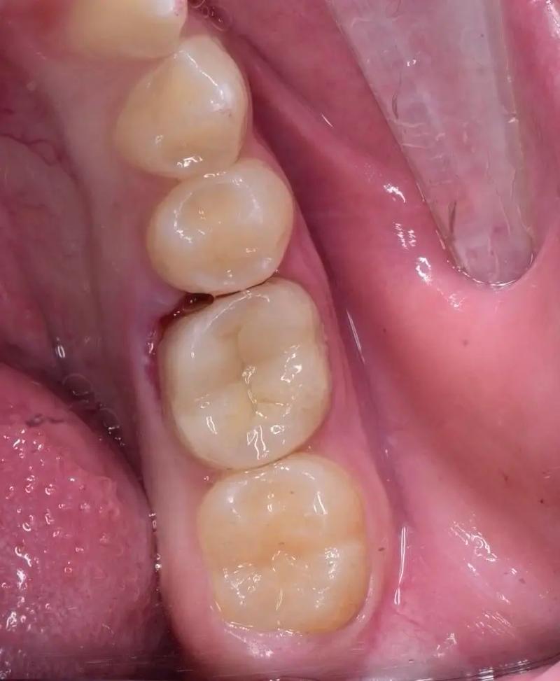 树脂充填后如何正确调合？关键步骤与操作要点是什么？-图1