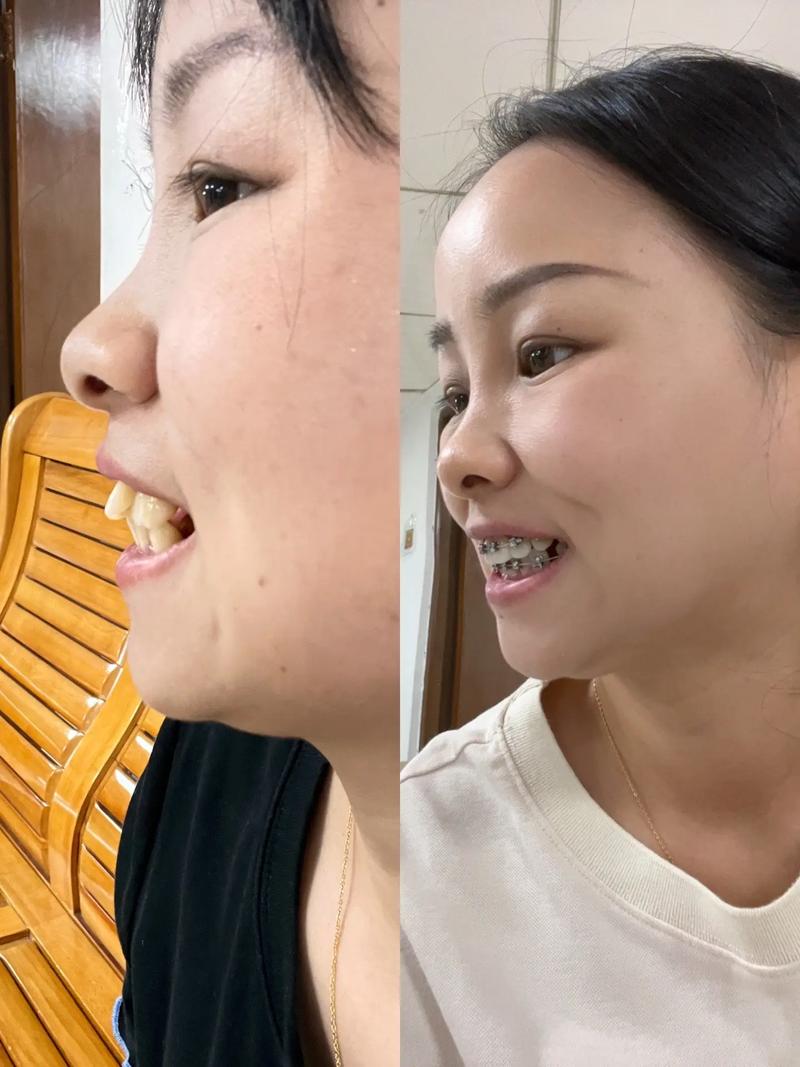 拔牙正畸前后脸型变化图-图1