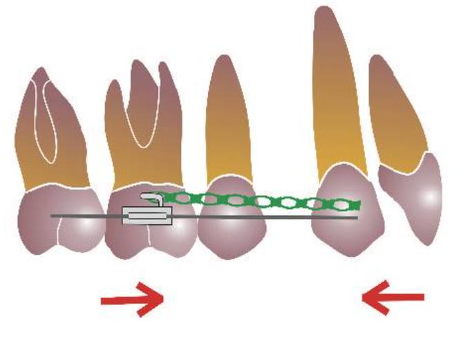 正畸关闭拔牙间隙有哪些常用方法？-图1