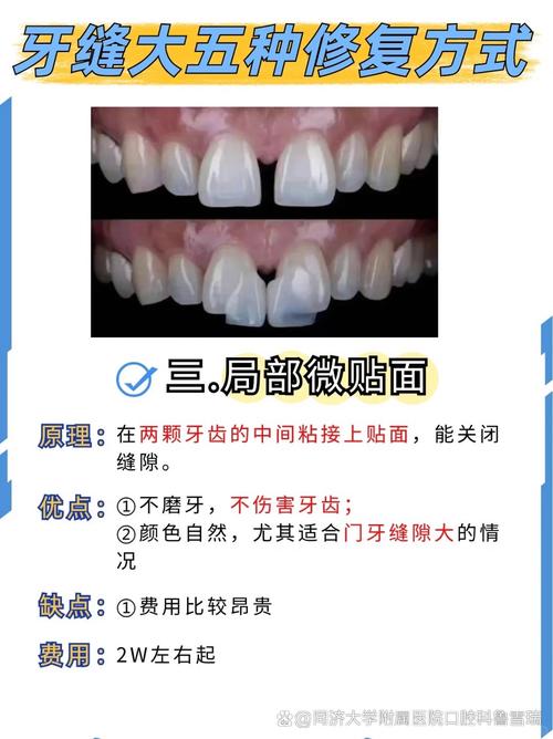 牙稀缝隙大可以种牙么-图1
