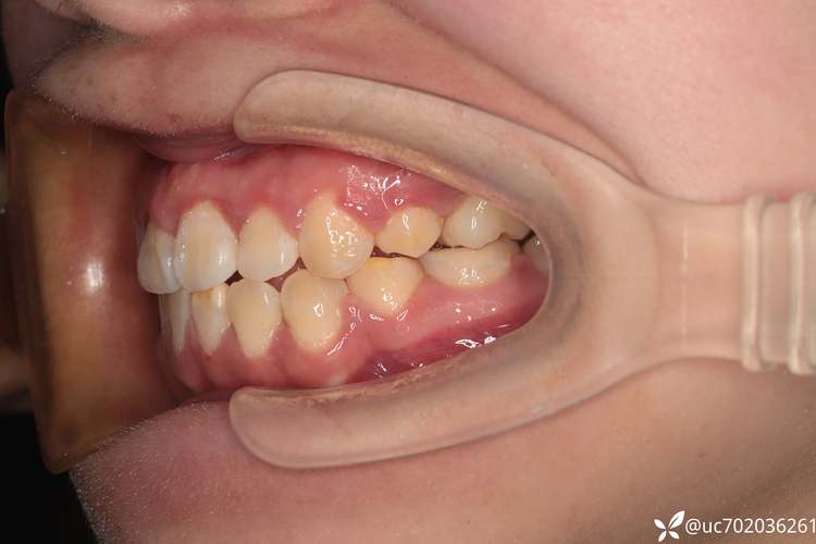 正畸拔牙一个月效果图效果如何？变化大不大？-图2