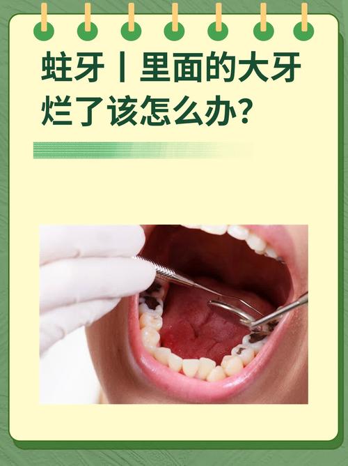蛀牙自己掉的方法存在吗?有哪些方式能实现?-图1 蛀牙自己掉的方法存在吗?有哪些方式能实现?-图1