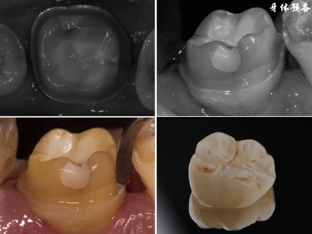 黄叶君前牙的预备方法-图1