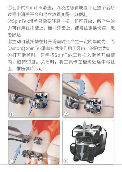 矫正方法中进口金属托槽矫正效果具体比普通托槽更好呢？-图1
