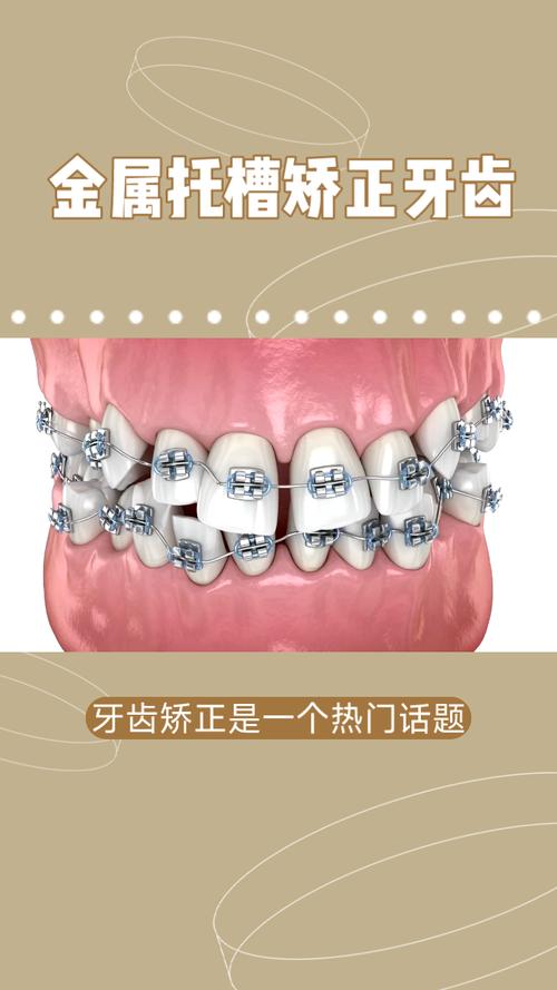 矫正方法中进口金属托槽矫正效果具体比普通托槽更好呢？-图2