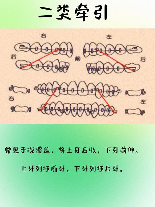 正畸二类二分类矫治的关键难点与突破点是什么？-图2