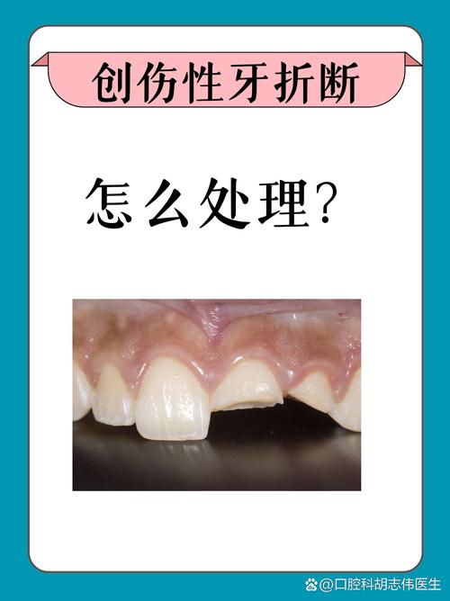 牙断了有哪些治疗方法?-图2 牙断了有哪些治疗方法?-图2