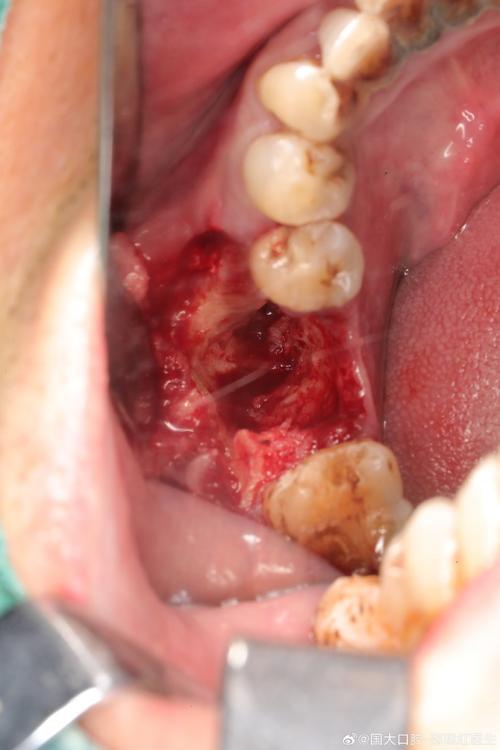 种牙种植体上面长出肉-图2