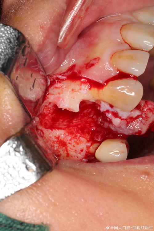 种牙种植体上面长出肉-图3