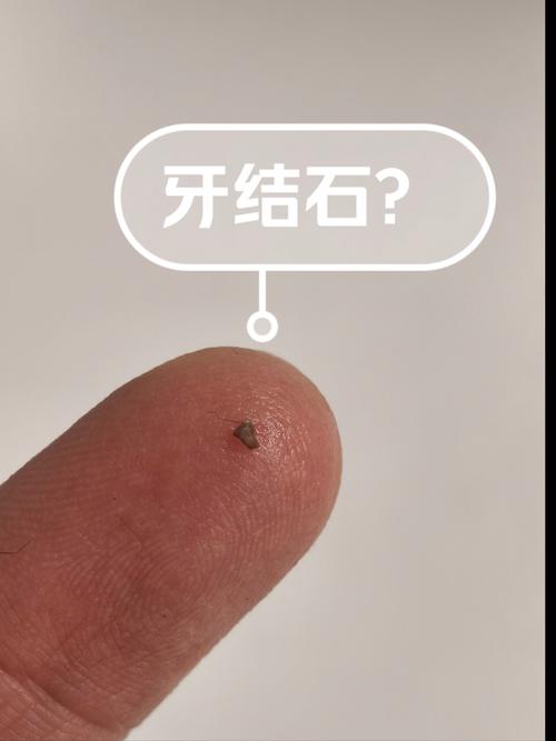 拜博口腔牙结石-图2