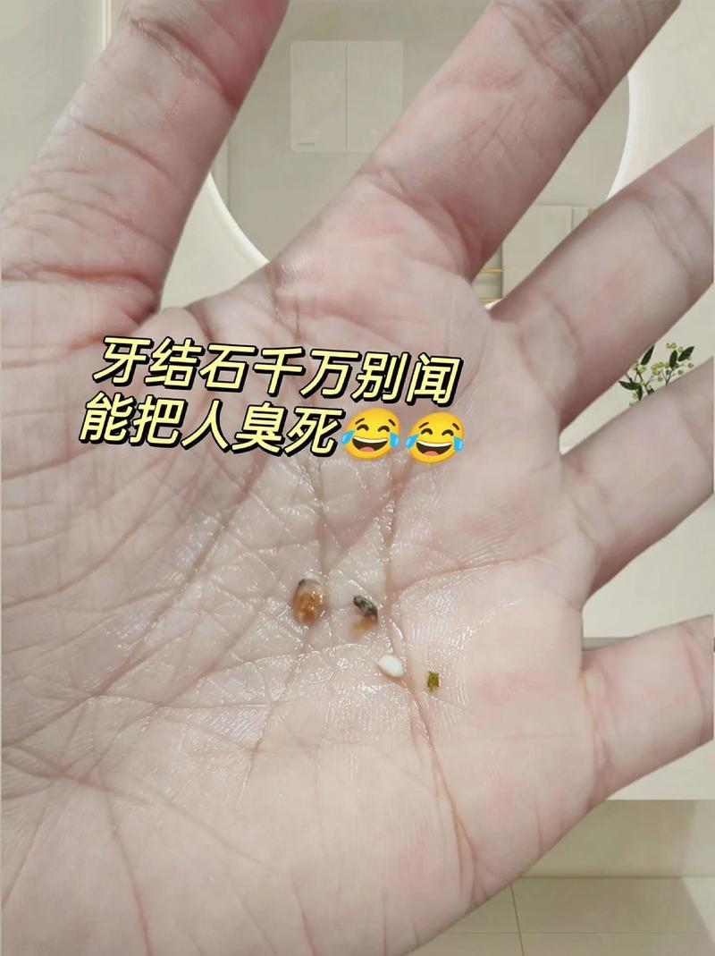 拜博口腔牙结石-图1