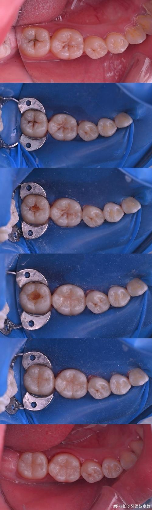 后牙形态树脂堆塑方法-图2