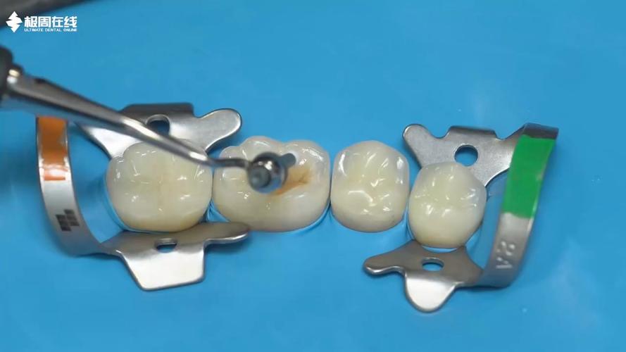 后牙形态树脂堆塑方法-图1