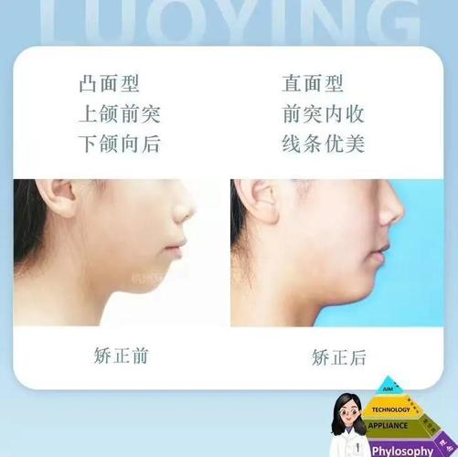 正畸拔牙一颗5一颗六-图3 正畸拔牙一颗5一颗六-图3