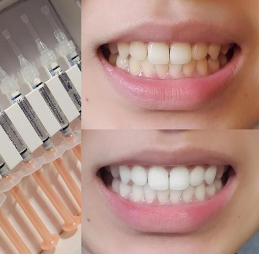 上海美白牙齿的有效方法有哪些？-图2