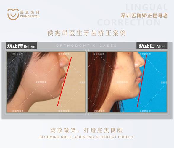 咬合侧偏一点点,正畸治疗有必要吗?-图1 咬合侧偏一点点,正畸治疗有必要吗?-图1