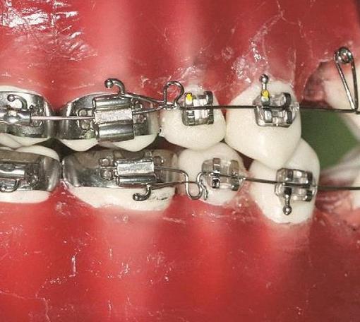 正畸弓丝弯制小自行车-图2