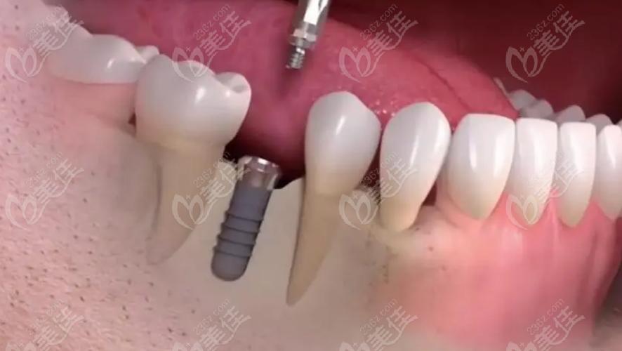 深圳哪里种牙比较好的-图3