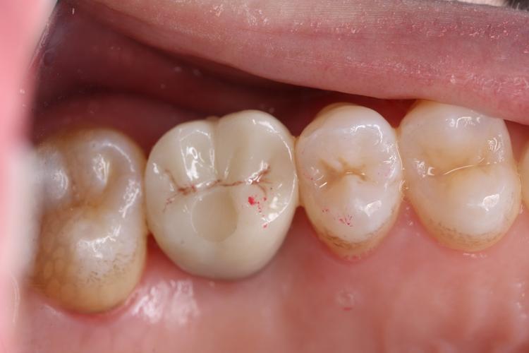 种植固定修复粘接方法-图1