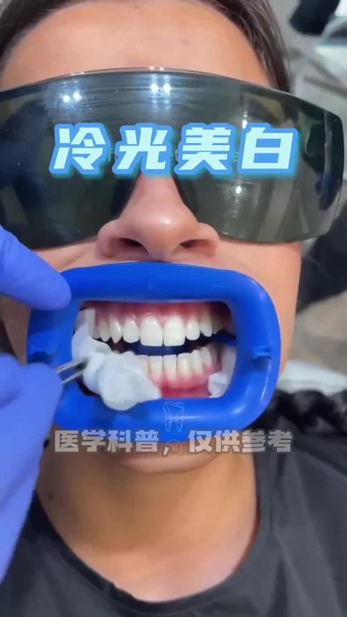 杭州冷光美白牙齿方法-图1