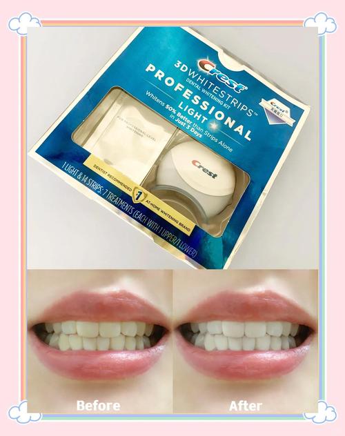 杭州冷光美白牙齿方法-图3