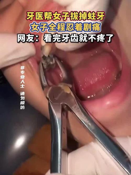 蛀牙拔了一定要种牙吗-图1