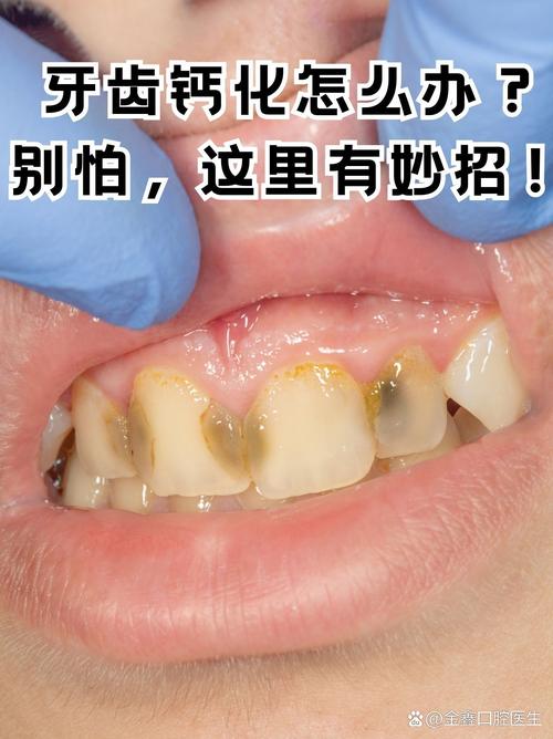 口腔钙化有哪些有效的治疗方法？-图1
