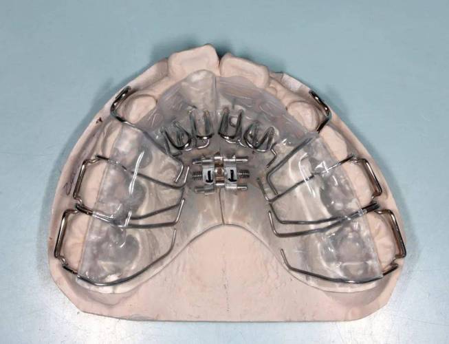正畸舌簧矫治器的弯制需掌握哪些关键步骤与实用操作技巧？-图1
