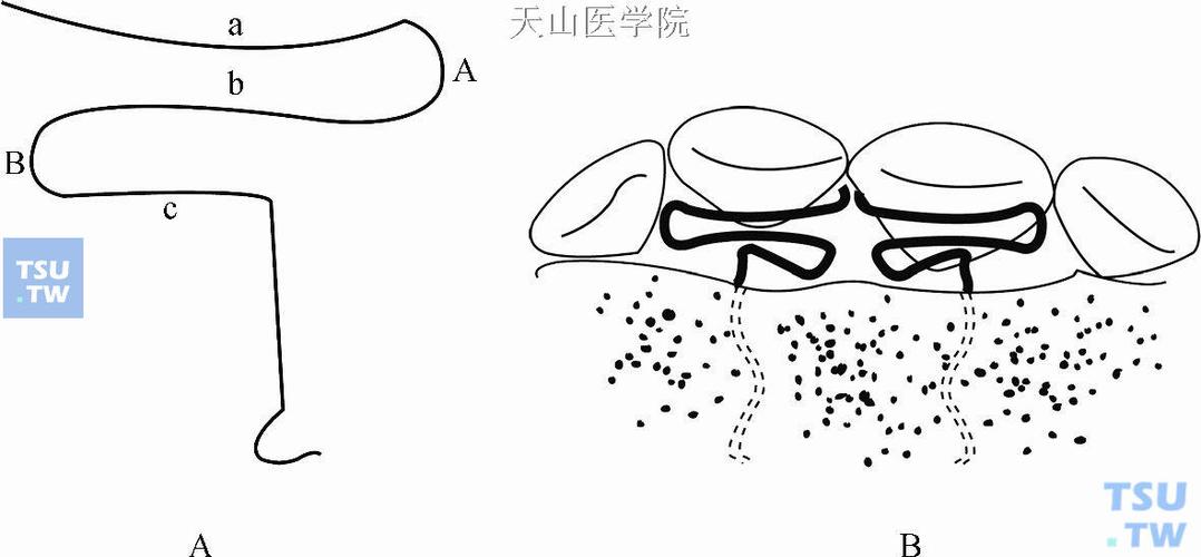 正畸舌簧矫治器的弯制需掌握哪些关键步骤与实用操作技巧？-图3