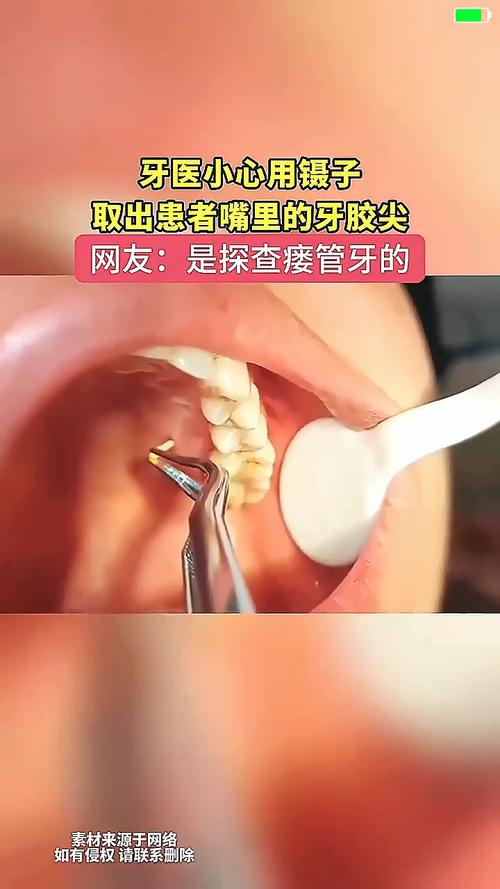 取出侧穿牙胶尖的方法-图2