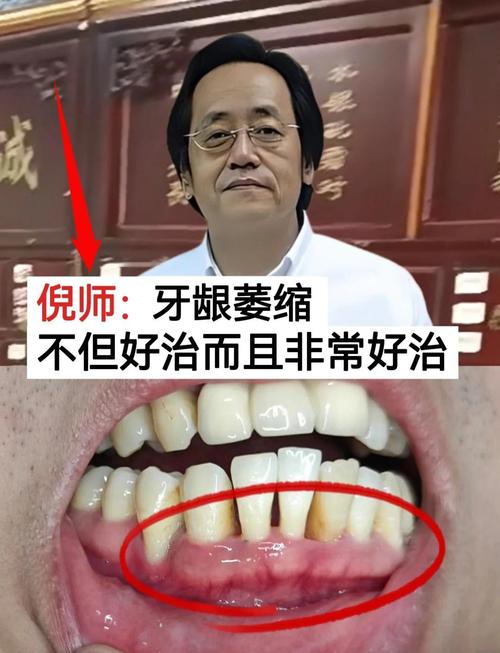 牙床萎缩恢复最佳方法-图3