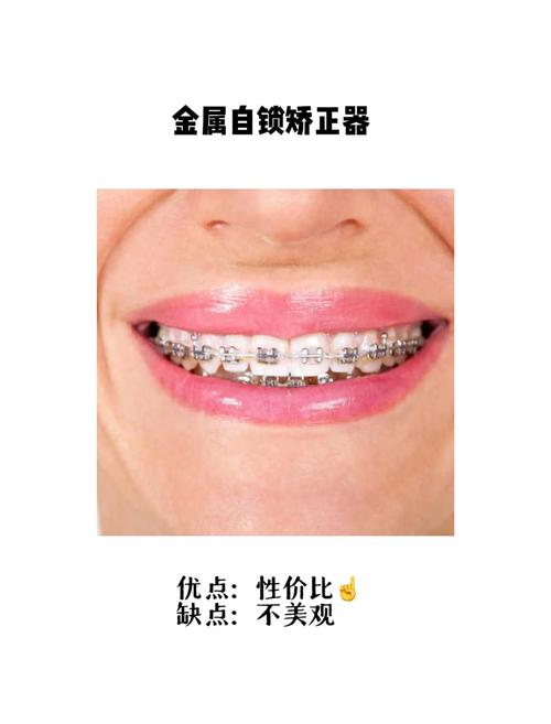 正畸要一直戴保持器么-图2