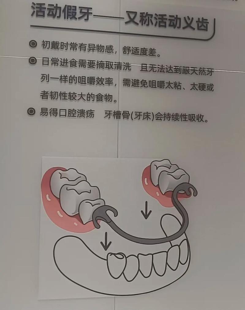 全口义齿装盒方法优点-图2