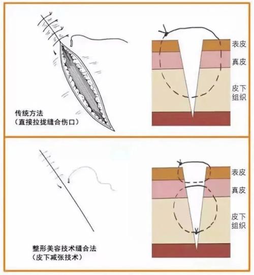 下颌智齿创口缝合方法-图3