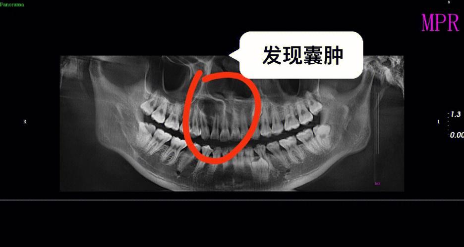 根尖囊肿术后有哪些治疗方法？如何根据病情选择最佳方案？-图1