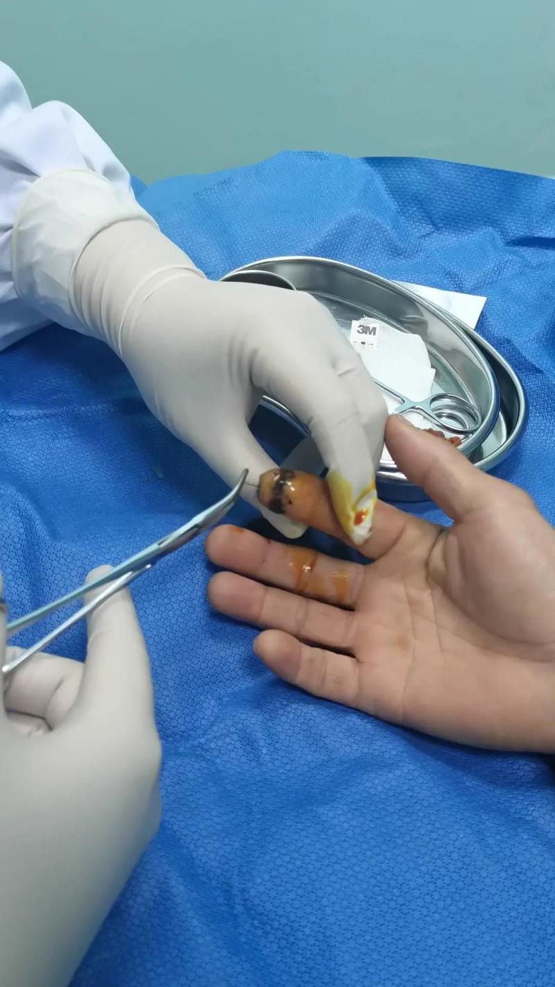 拔髓针的正确方法视频-图1