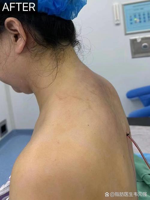 拔髓针的正确方法视频-图3