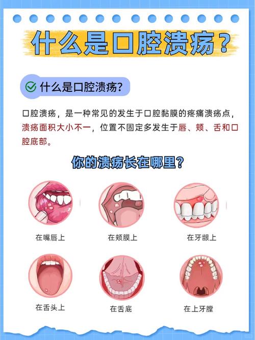 口腔黏膜封闭治疗方法的作用原理、操作规范及临床应用效果有哪些？-图1