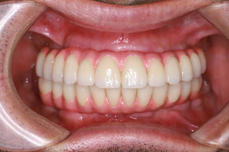 种牙费用是一次性交清还是可分期？支付方式有几种选择？-图1