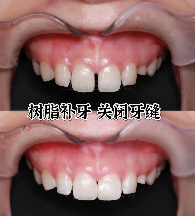 牙缝大有什么方法修补-图2 牙缝大有什么方法修补-图2