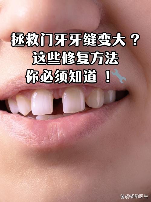 牙缝大有什么方法修补-图1 牙缝大有什么方法修补-图1