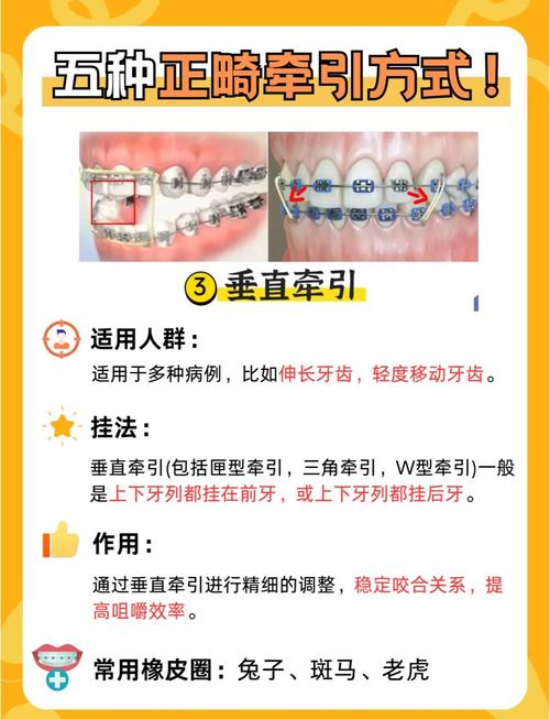 正畸橡皮圈一天带多久-图2