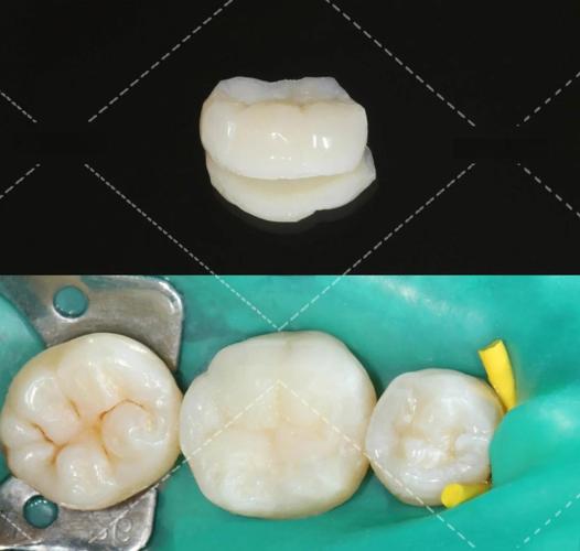 聚合瓷嵌体粘结方法的关键步骤、材料选择及注意事项有哪些?-图1 聚合瓷嵌体粘结方法的关键步骤、材料选择及注意事项有哪些?-图1