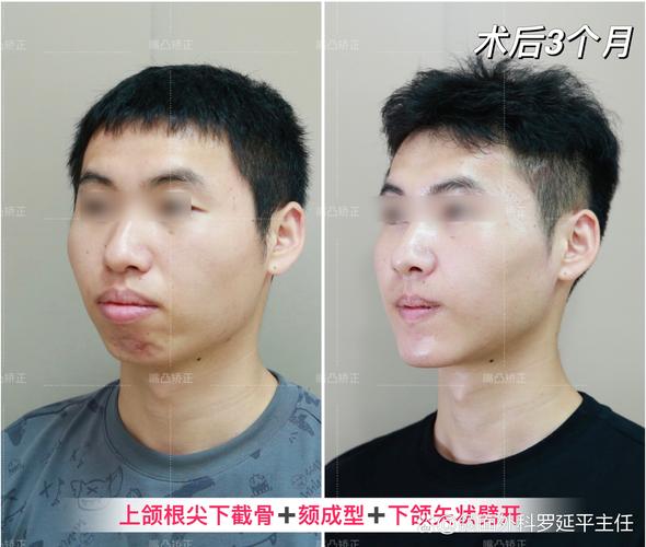 正畸跟着正颚外科一起-图1