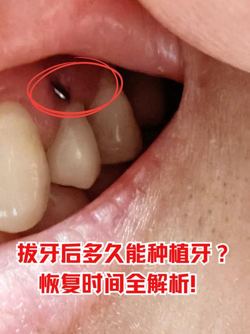 刚种完牙怎么看不到-图2