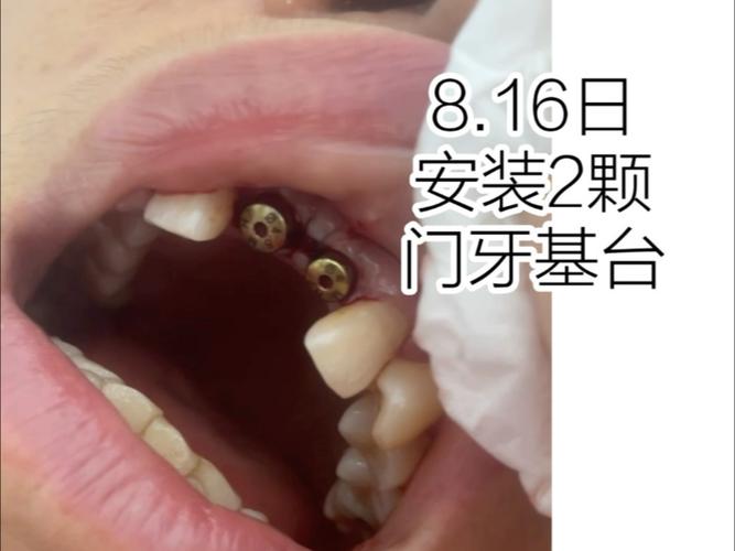 2颗牙可以种一棵吗？-图1