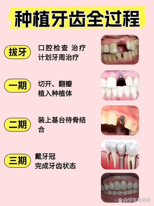 2颗牙可以种一棵吗？-图3