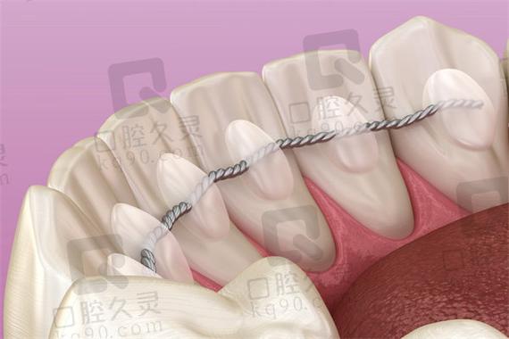 固定松动牙齿,哪种方法最有效可靠?-图1 固定松动牙齿,哪种方法最有效可靠?-图1
