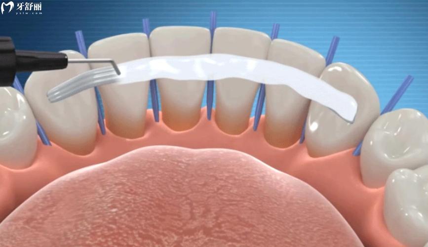 固定松动牙齿,哪种方法最有效可靠?-图2 固定松动牙齿,哪种方法最有效可靠?-图2