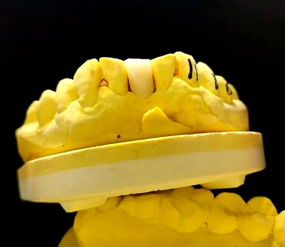 种牙后做的马里兰桥-图1